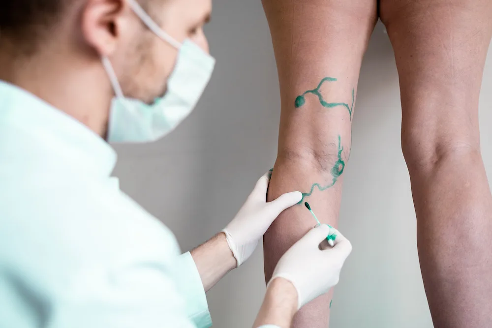 Vein markup. Vascular surgeon is marking veins for varicose surgery.