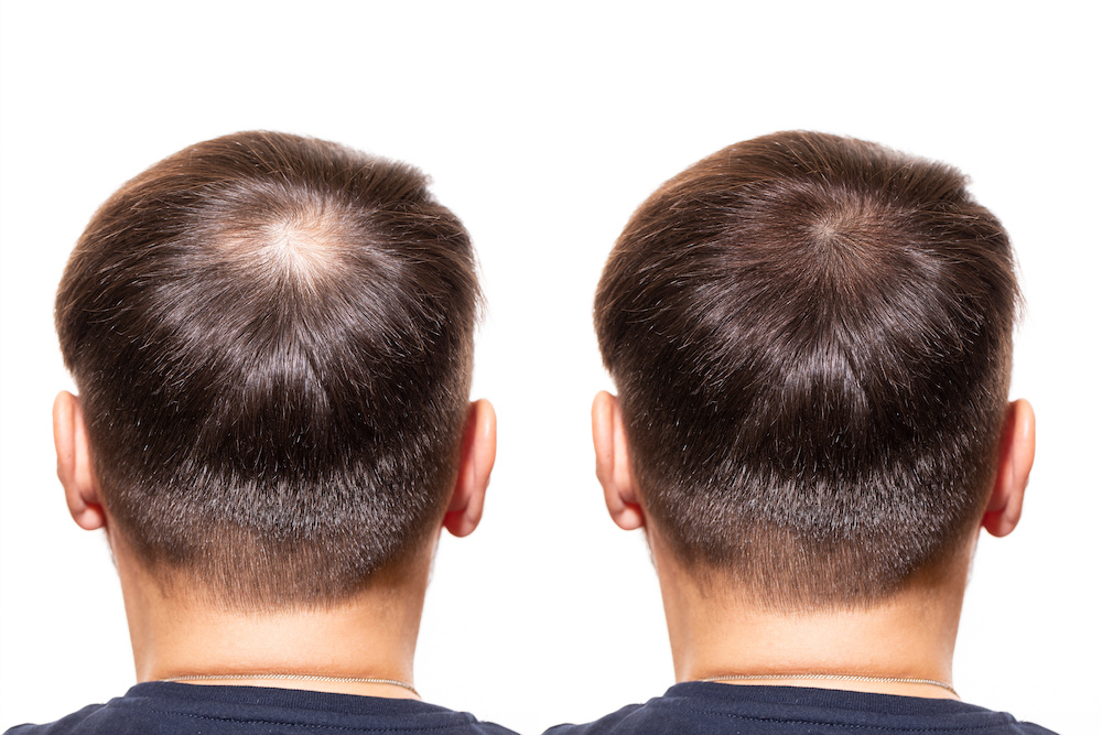 5. Using Light Blue Therapy to Combat Hair Loss and Thinning - wide 11