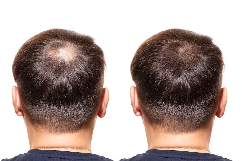Hair loss. Men view from the back, comparison of hair before and after PRP treatment