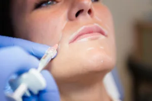 filler in the smile lines