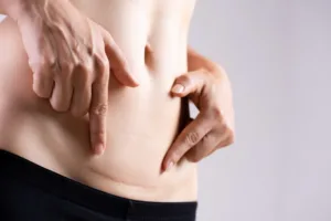 A woman pointing to a C-Section scar.