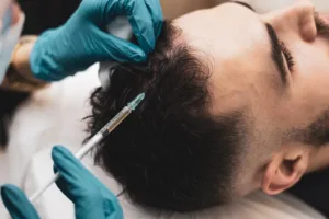 A man receiving PRP hair treatment.